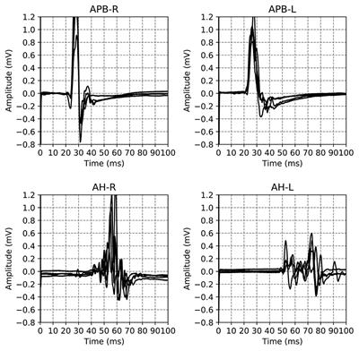 Deciphering the Morphology of Motor Evoked Potentials